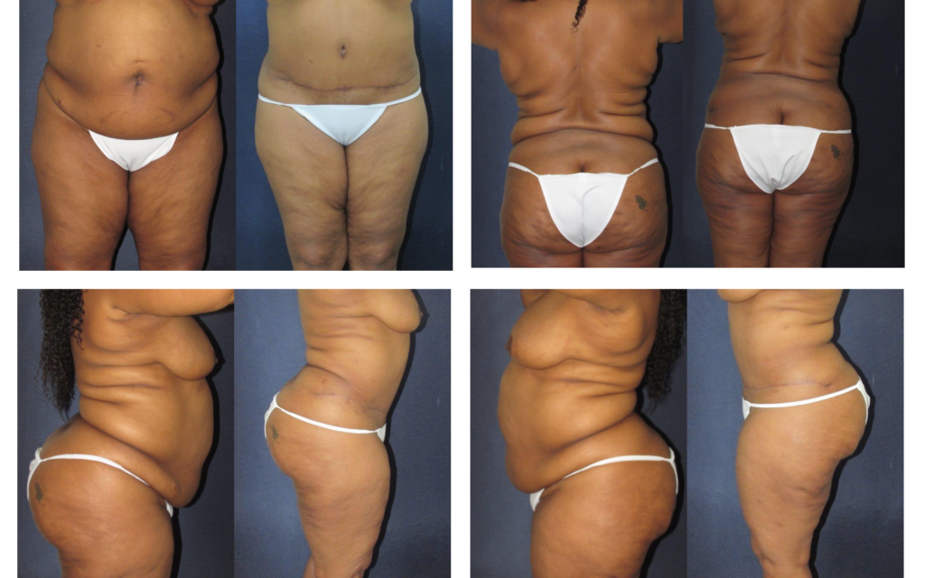Before and After Image: Patient # 6151 - other